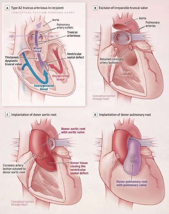 μεταμόσχευση καρδιάς βρέφος