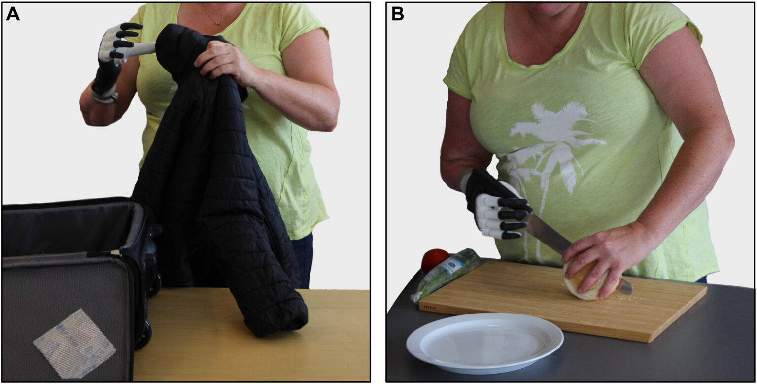 βιονικό χέρι Σουηδία