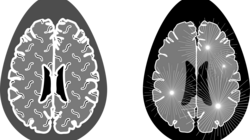 Σκλήρυνση κατά πλάκας: Μπορεί να ξεκινά πάνω από 10 χρόνια πριν τα συμπτώματα