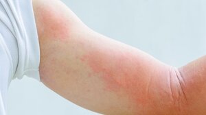 Πώς συνδέεται το έκζεμα και το άγχος;