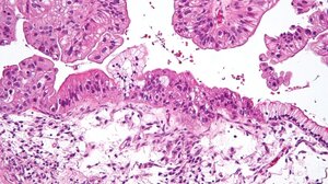 Νέος συνδυασμός φαρμάκων συρρικνώνει σημαντικά τους όγκους των ωοθηκών