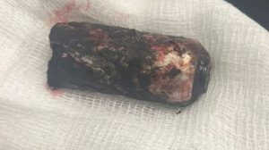 Σοκαριστική φωτογραφία: Το βλήμα της ναυτικής φωτοβολίδας που αφαιρέθηκε από τον μηρό του αστυνομικού