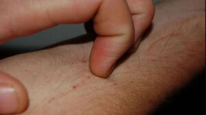 Έκζεμα και μπάνιο: Τι πρέπει να γνωρίζετε