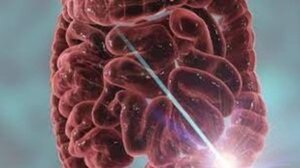 Καρκίνος παχέος εντέρου: Ο πρώτος προγνωστικός παράγοντας για τους κάτω των 50 ετών