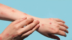 Δεύτερο κοριτσάκι πεθαίνει από ιλαρά στις ΗΠΑ