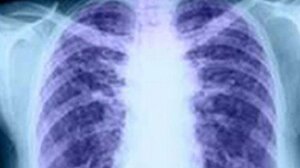 Ο καρκίνος του πνεύμονα είναι ο πιο θανατηφόρος καρκίνος στον πλανήτη