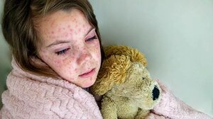 Ιλαρά: Ραγδαία αύξηση κρουσμάτων στην Ευρώπη - Τα δεδομένα στην Ελλάδα