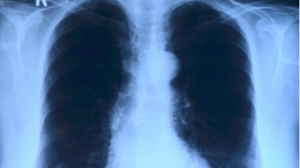 Ένα στους δύο με ΧΑΠ έχει καρδιολογικό πρόβλημα