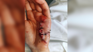 Επίθεση από τσομπανόσκυλο: «υποφέρω από κρίσεις πανικού, το χέρι δεν θα επανέλθει πλήρως»