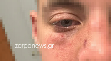 Το τραυματισμένο μάτι 