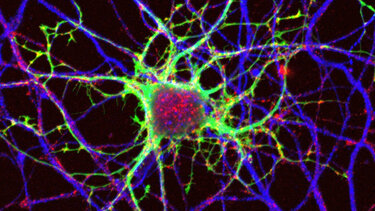 Πολλαπλή σκλήρυνση: Άκρως ενθαρρυντικά αποτελέσματα από πειραματική θεραπεία