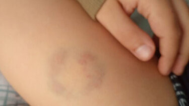 Διευθύντρια ειδικού σχολείου δάγκωσε μαθητή - Μήνυση από την μητέρα