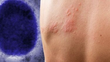 «Ευλογιά των πιθήκων»: Σε εγρήγορση ο ΕΟΔΥ, έστειλε εγκύκλιο στα νοσοκομεία