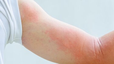 Πώς συνδέεται το έκζεμα και το άγχος;