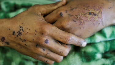 Τρεις νεκροί από χολέρα στη Ράκα και το Ντέιρ Εζόρ