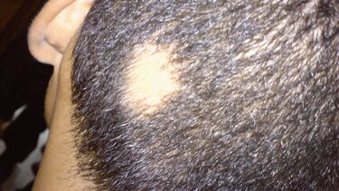 ΗΠΑ: Εγκρίθηκε νέο φάρμακο για την γυροειδή αλωπεκία