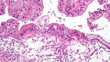 Νέος συνδυασμός φαρμάκων συρρικνώνει σημαντικά τους όγκους των ωοθηκών