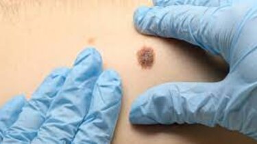 Τι μπορεί να σημαίνει μια ελιά που αιμορραγεί;