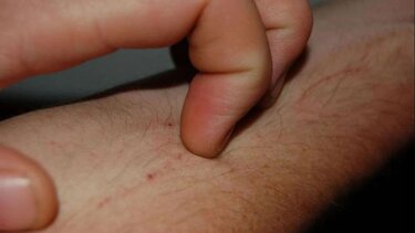 Έκζεμα και μπάνιο: Τι πρέπει να γνωρίζετε