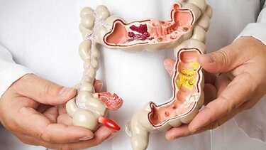 Οι παρεμβάσεις στη διάθεση μπορούν να μειώσουν τη φλεγμονή στη νόσο του Crohn και την ελκώδη κολίτιδα