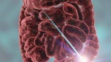 Καρκίνος παχέος εντέρου: Ο πρώτος προγνωστικός παράγοντας για τους κάτω των 50 ετών