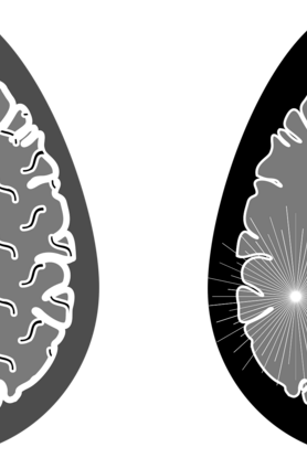 Σκλήρυνση κατά πλάκας: Μπορεί να ξεκινά πάνω από 10 χρόνια πριν τα συμπτώματα