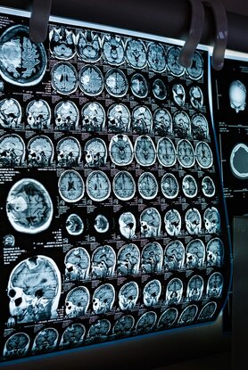 Η Τεχνητή Νοημοσύνη μπορεί να «προβλέψει» τη νόσο Αλτσχάιμερ με ακρίβεια 92,8%