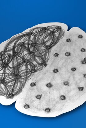 Αλτσχάιμερ: Η νέα εξέταση αίματος που αλλάζει τα πάντα - Τι πρέπει να γνωρίζετε